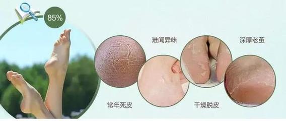 「芯迈足部小科普」老年人应该如何护理足部?